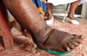 जिले में 10 फरवरी से 25 फरवरी तक चलेगा फाइलेरिया उन्मूलन कार्यक्रम,आंगनबाड़ी स्कूल एवं शैक्षणिक संस्थानों में दवा का किया जायेगा वितरण